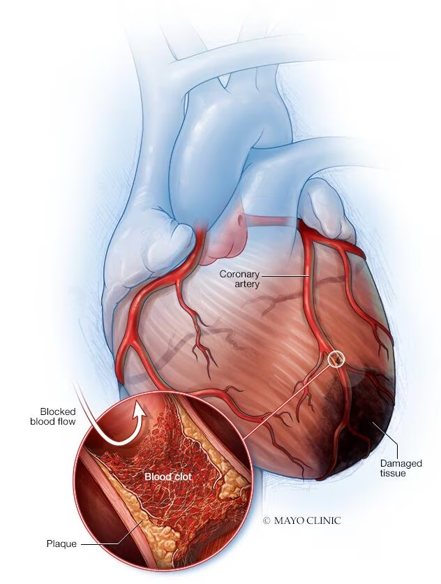 What To Know About Heart Attacks